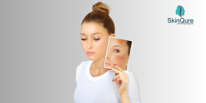 5 Hyperpigmentation Treatments That Really Work