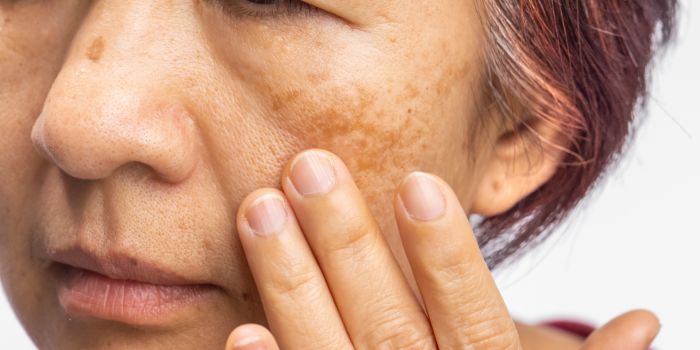 What are the effective ways for Melasma pigmentation treatment in Delhi?