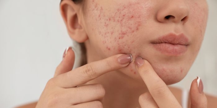 How Dermatologists in Delhi Effectively Treat Acne Scars?