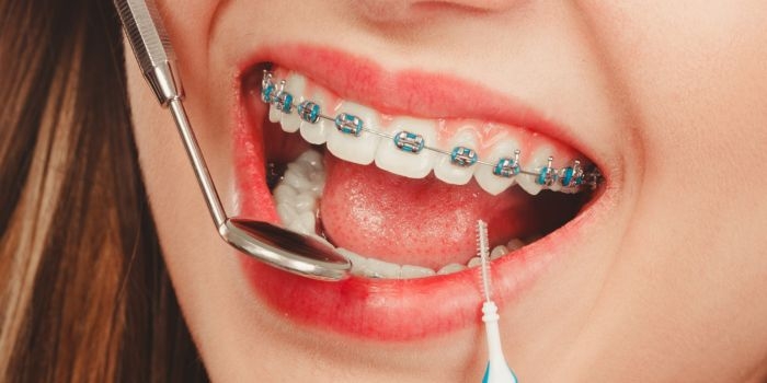 Finding the Best Orthodontist to Straighten Your Teeth