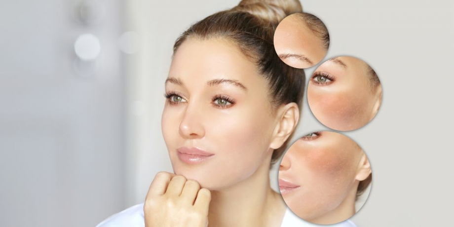 Melasma: Causes, Prevention & Melasma treatment in Delhi  