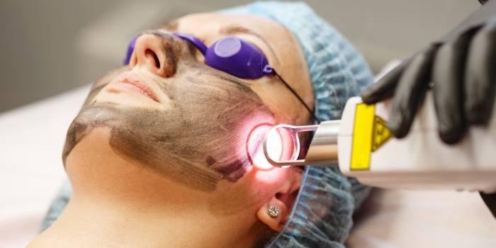 Why Carbon Facial in Delhi is the go to treatment for glowing 