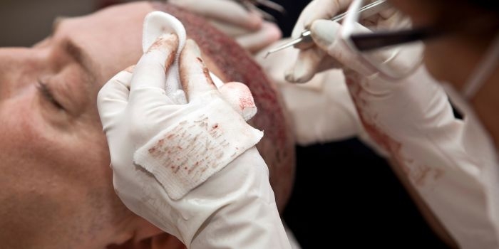 Hair Transplantation: Get expert Care by the Best Hair Transplant Doctor in Delhi