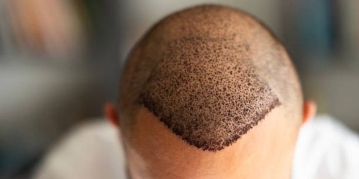 Why is Delhi becoming a hub for advanced hair transplant procedures?