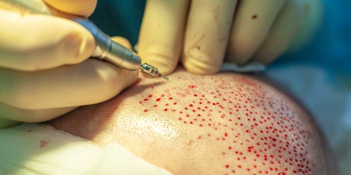 Best Hair Transplant Technique in Delhi: Types, Benefits & Procedure