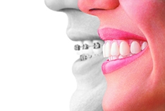 Achieve a Confident Smile with Invisalign – Your Guide to Modern Orthodontics