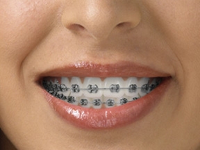 Achieve a Confident Smile with Expert Braces