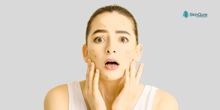 Best Acne Treatment in Punjabi Bagh | Expert Dermatologist for Acne Pigmentation