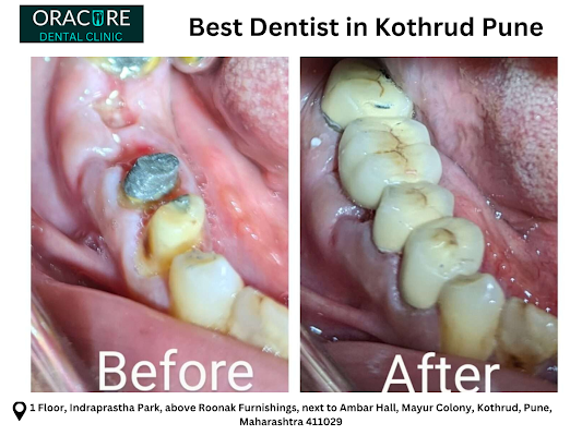 Walk In Dental Treatments in Kothrud – Your Trusted Solution for Quick & Quality Oral Care