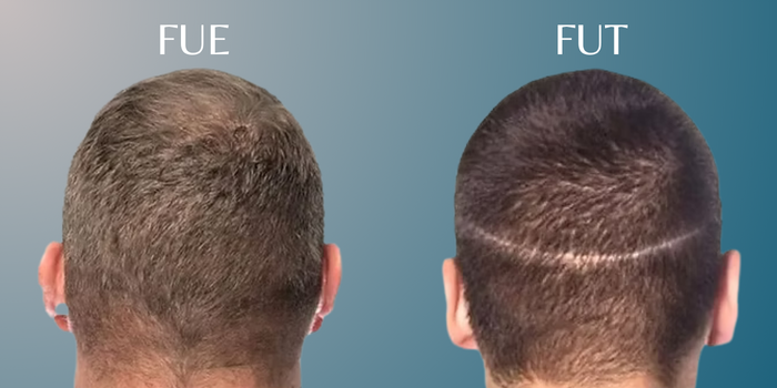 Hair Transplant Techniques Popular in Delhi: FUT vs. FUE