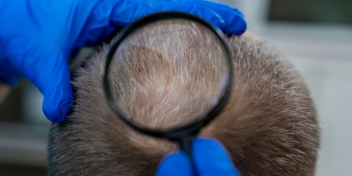 DHI Hair Transplant: A Precise and Painless Hair Restoration Technique in Delhi