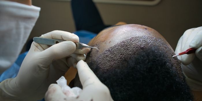 Hair Transplant on Scar: A Life-Changing Solution for Natural Hair Growth in Delhi