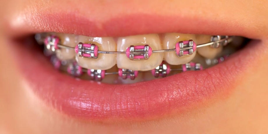 Braces in Delhi – Transform Your Smile with Dentem Clinic