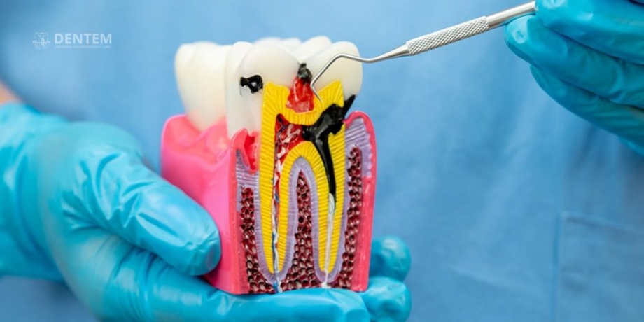 Your Trusted Endodontist in Delhi for Pain-Free Dental Care