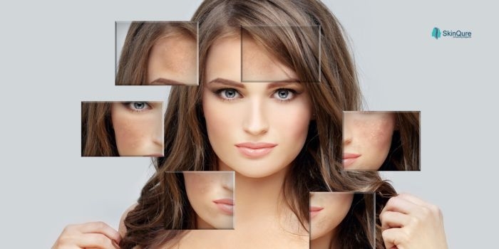 Say Goodbye to Dark Patches: Best Melasma Pigmentation Treatment in Delhi