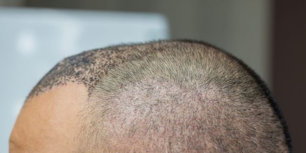 How to Manage Pain During a Hair Transplant: Expert Tips from Top Clinics in Delhi