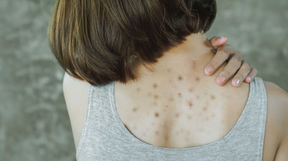 Shoulder Acne: Causes, Treatments, and How to Prevent Breakouts