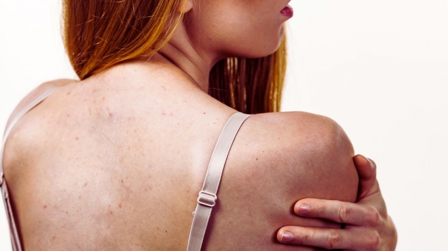 How to Get Rid of Shoulder Acne Fast: Expert Tips That Work