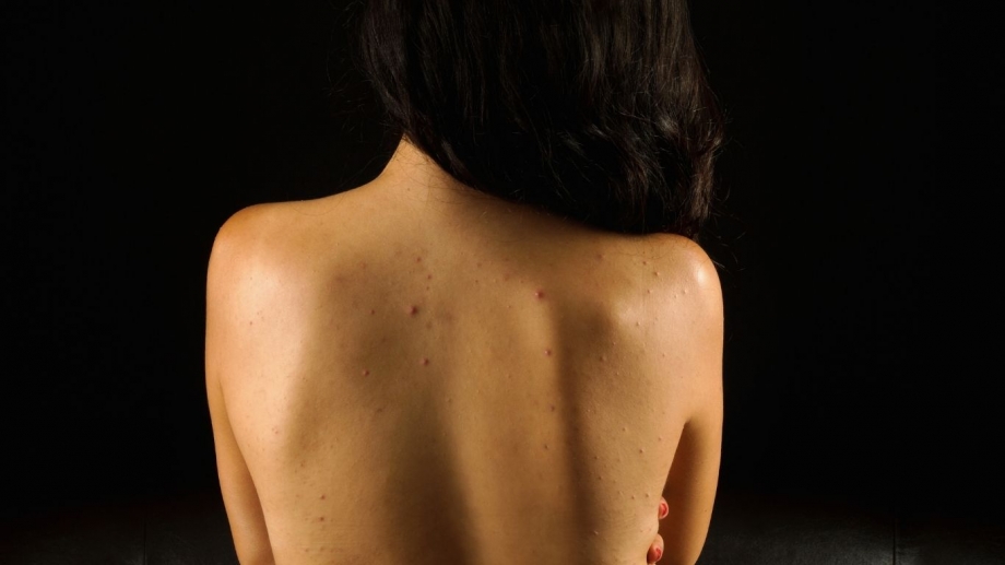 The Complete Guide to Shoulder Acne: From Triggers to Clear Skin