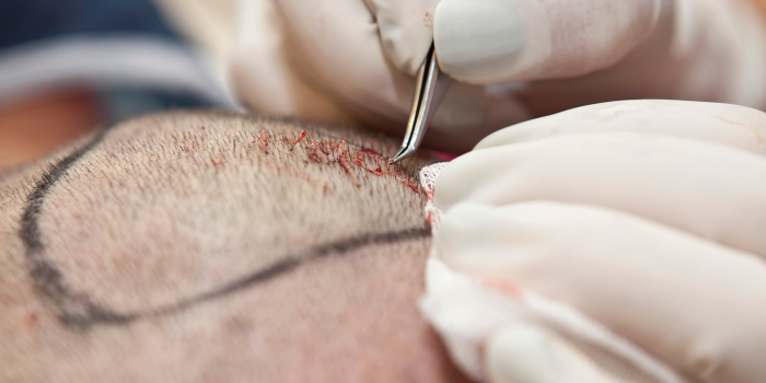 A Detailed Guide on Normal Hair Transplant vs Corrective Hair Transplant in Delhi