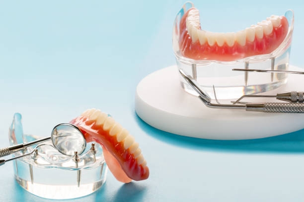 Snap-In Dentures: A Secure and Comfortable Solution for Missing Teeth