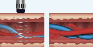 How Shockwave Therapy in Colorado Springs Improves Quality of Life