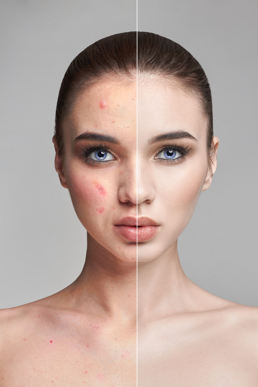 Acne treatment in Delhi: types, causes, effective solutions & cost breakdown