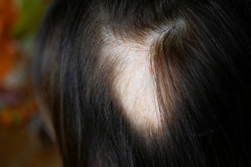 Effective alopecia areata treatment options you must know: Treatment procedure & benefits