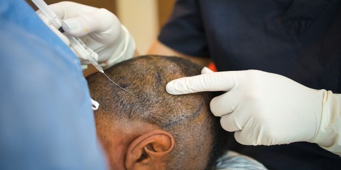 Best Hair Transplant Cost in Delhi - HairBud’s Complete Guide
