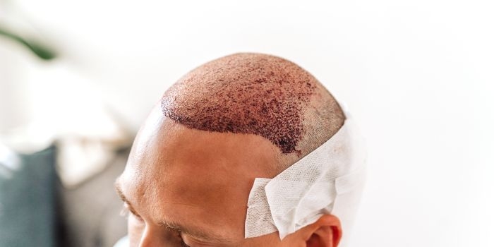 Why Delhi is the Preferred Destination for Hair Transplant Treatments