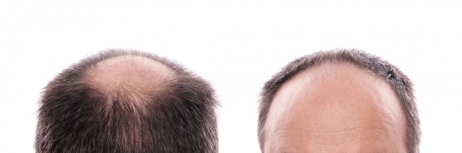 DHI vs FUE Hair Transplant: Choosing the Right Method for Natural Hair Growth