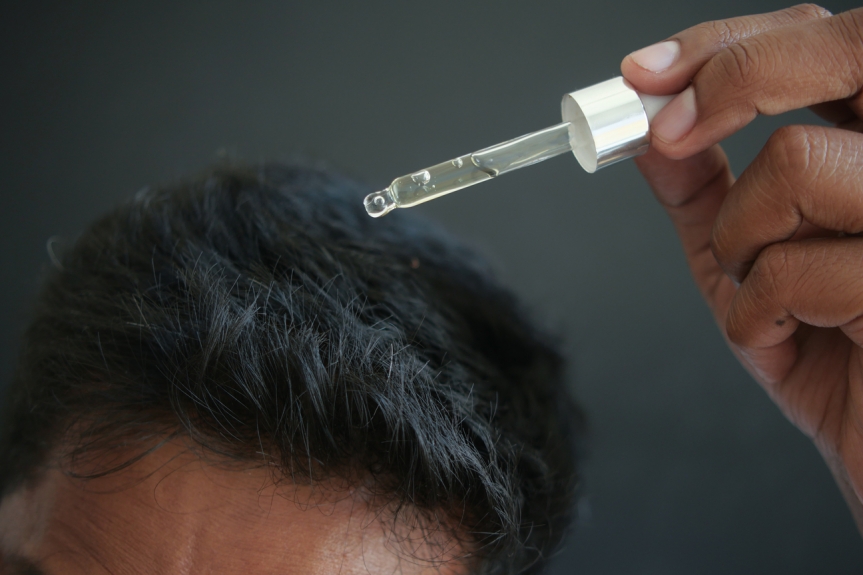 Minoxidil and Finasteride After Hair Transplant: A Detailed Guide