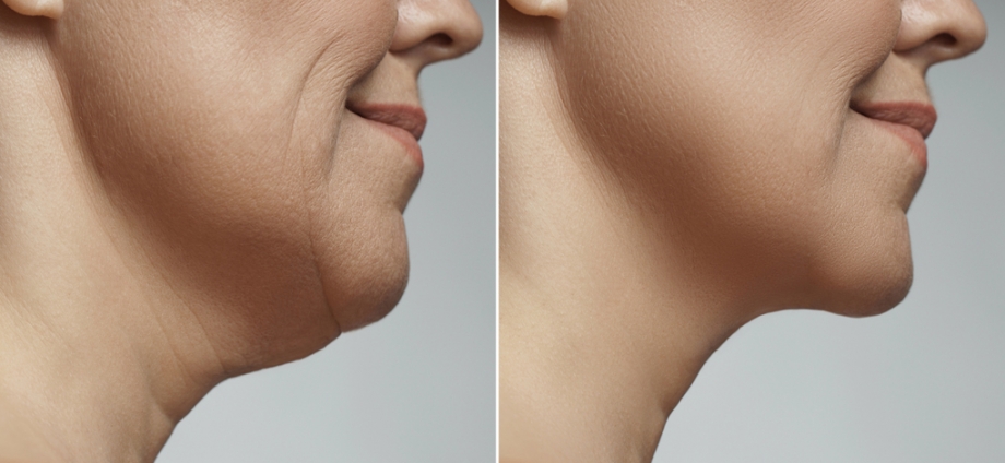How HIFU Treatment in Delhi Helps in Double Chin Reduction Naturally?