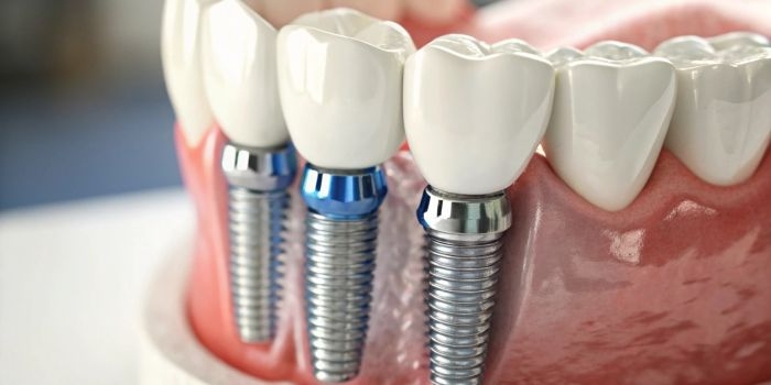 Implantology Courses in Delhi at Dr Khullar Dental Academy