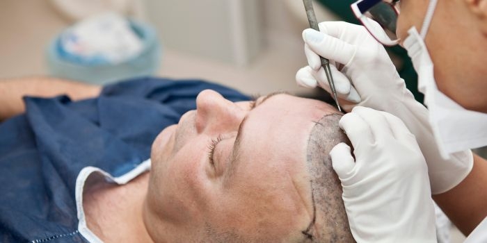Top Hair Transplant Doctor in Saket
