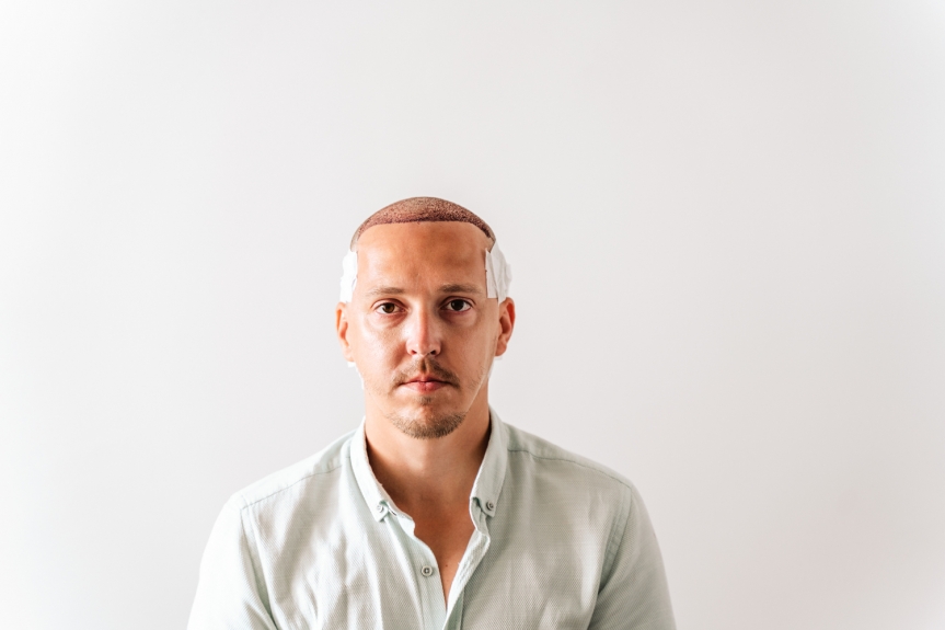 Factors affecting hair transplant price in delhi: Here’s the Complete Guide