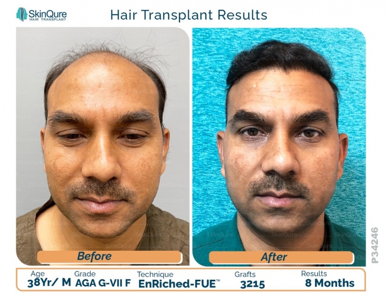 What Results Can You Expect from FUE Hair Transplant?