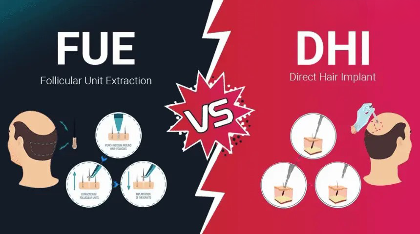 Choosing the Right Option: Understanding Dhi vs Fue Hair Transplant Cost in Delhi