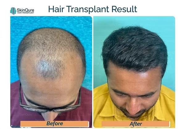 Know all about Dhi hair transplant cost in Delhi for Better Results