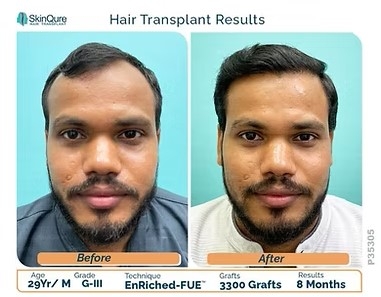 Before and After: Real Hair Transplant Results in Delhi You Need to See