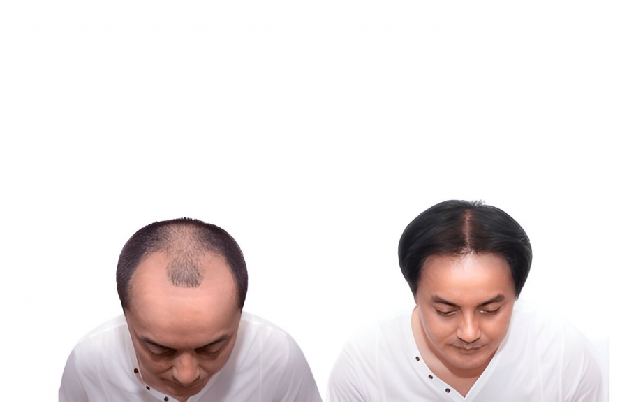 Price of Hair Transplant in Delhi: Know about Affordable Solutions for Everyone