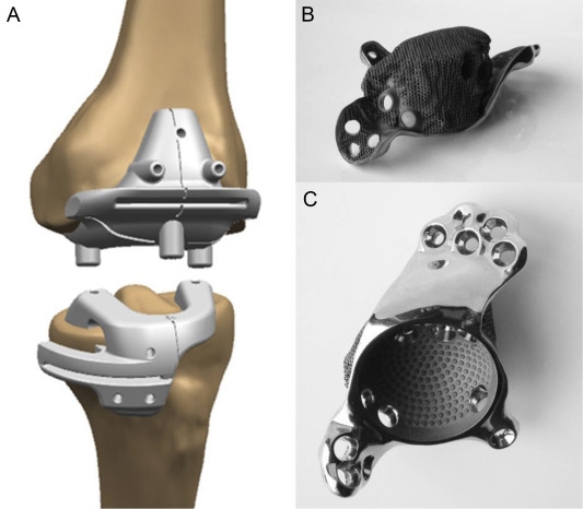 3D-Printed Hip and Knee Implant Market Insights Highlighting Robotic Integration, Smart Implants, and Surgical Precision