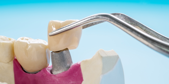 Prosthodontics Training in Delhi: Advancing Skills with Dr Khullar Dental Academy