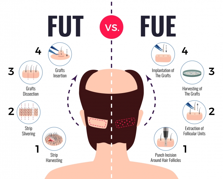 Hair transplant in delhi FUE vs FUT scarring scar prevention