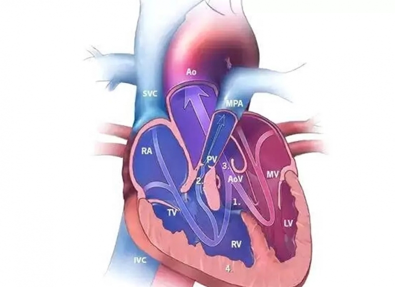 Tetralogy of Fallot: A Century-Long Journey from Despair to Hope, and the Compassionate Hearts of Healers Who Opened the Path of Life