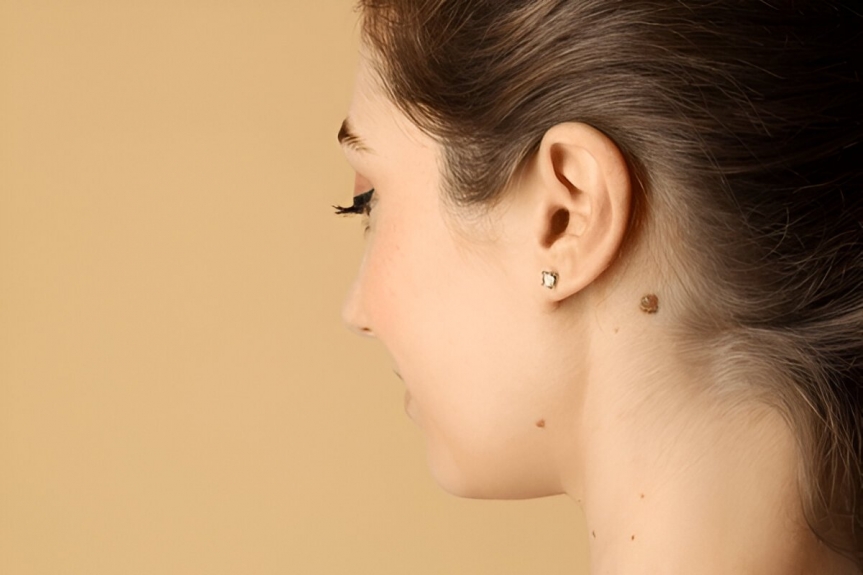 Side view of a woman with visible moles on her neck, showing areas commonly treated during safe and scarless mole removal procedures.