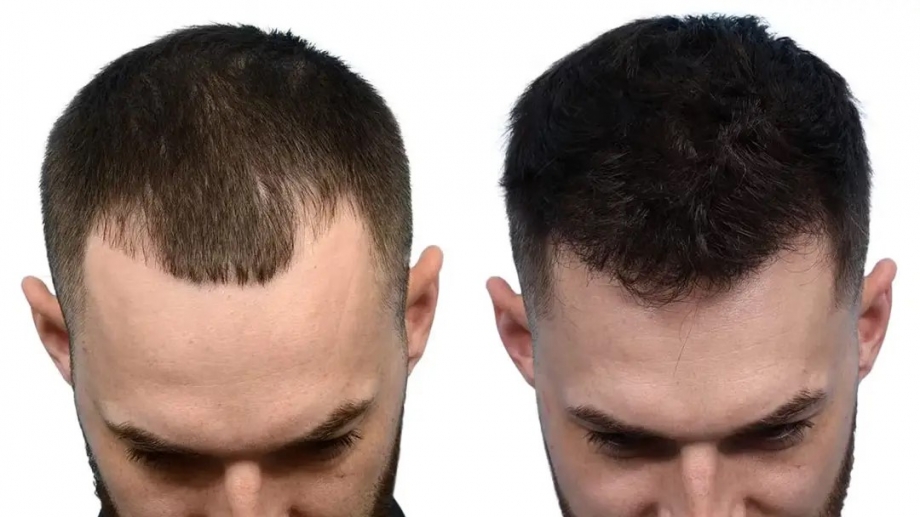 Before and after hair transplant comparison showing improved hair density and natural-looking hairline results.