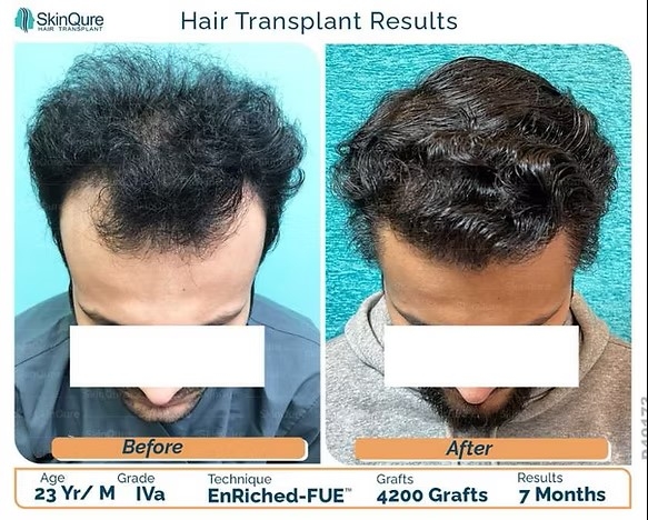 FUE hair transplant results showing a young male patient’s before-and-after comparison, with improved hair density and natural hairline after 4200 grafts at 7 months.