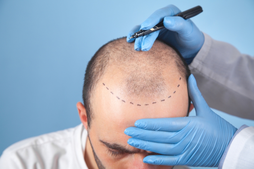 Doctor marking a patient’s hairline before a hair transplant procedure, illustrating FUE and DHI hair restoration techniques.